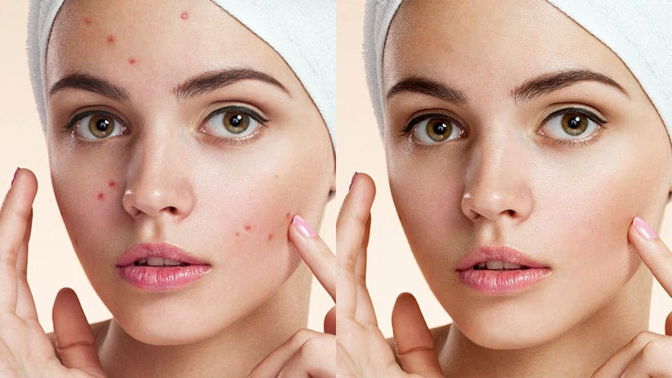 5 easy ways to clean blemishes and heal skin in Photoshop