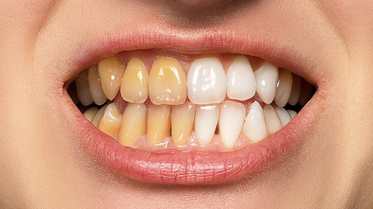 The best way to whiten teeth in Photoshop