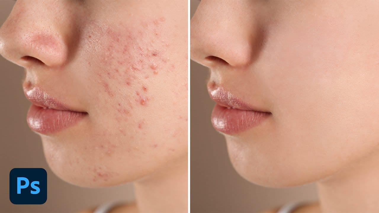 How to easily remove acne and blemishes in Photoshop