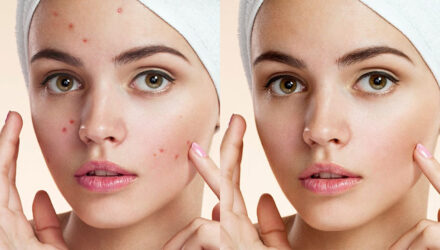 5 easy ways to clean blemishes and heal skin in Photoshop